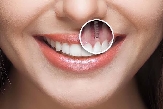 implant